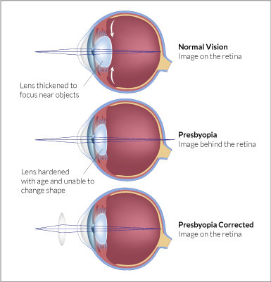 What is Presbyopia | Glasses Gallery | Eye care information